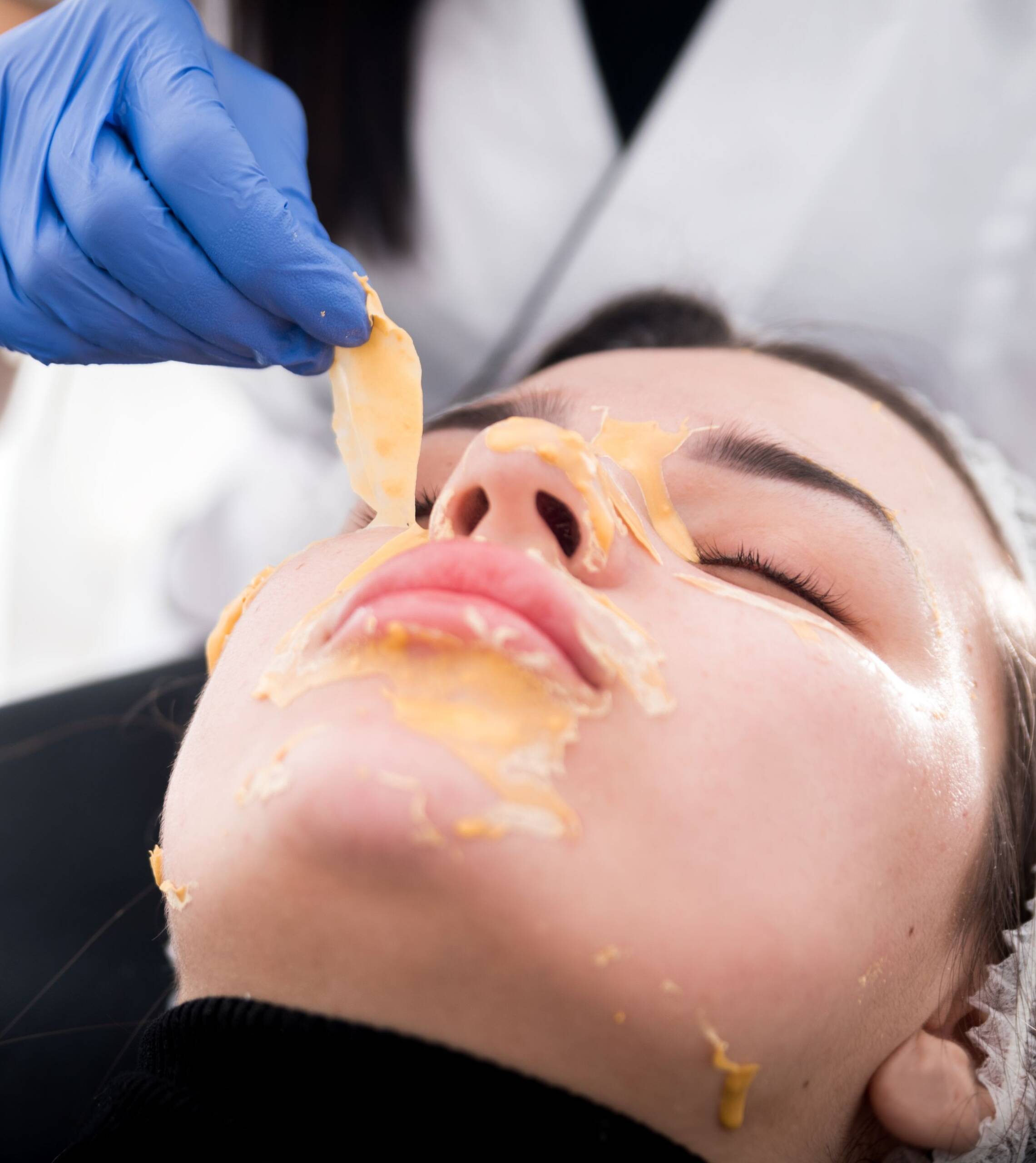 ΧΗΜΙΚΑ PEELINGS